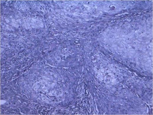 Sheets of malignant squamous cells (400x H and E stain)