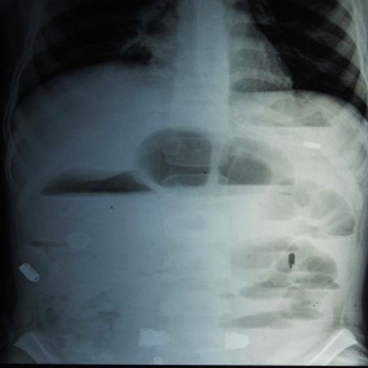 X-ray film showing significant air fluid levels and dilated small bowel loops.