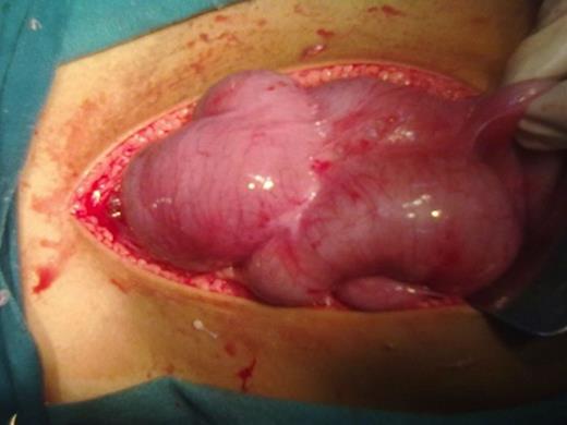 Intra operative Snapshot showing adherent gut loops encased in a membrane.