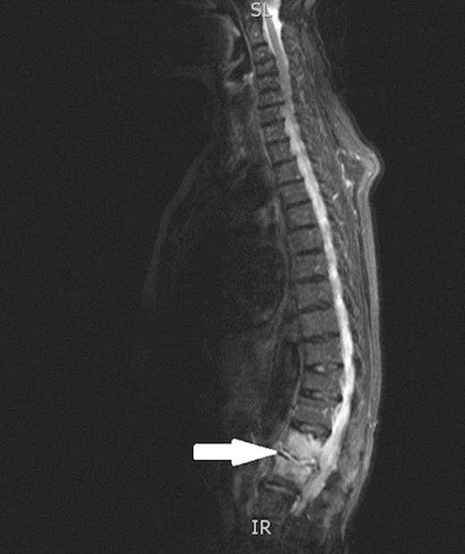 Sagittal view of MRI scans of spine confirming discitis of L1/L2 (indicated by arrow).