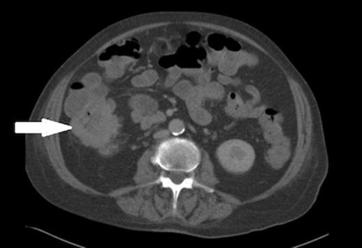 Axial view of the CT abdomen showing thickening of the ascending colon (indicated by arrow).