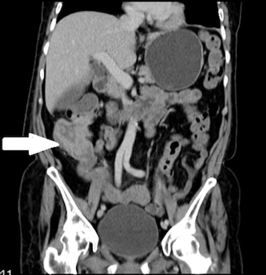 Coronal view of the CT abdomen showing thickening of the ascending colon (indicated by arrow).