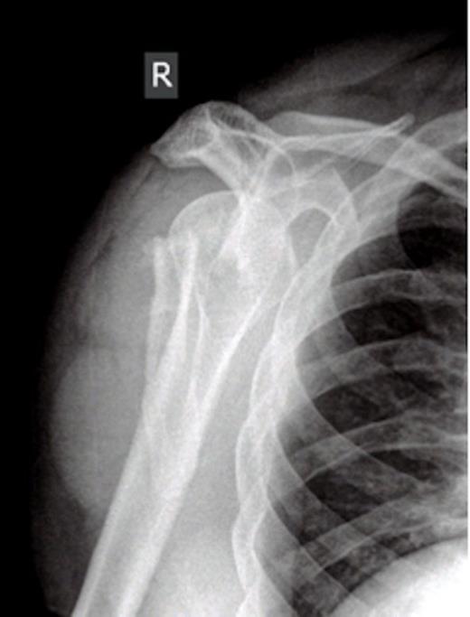 Radiograph showing fracture to blade of scapula