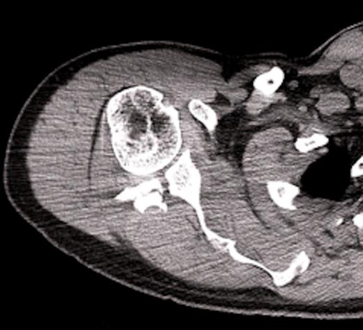 Computed tomographic scan, showing fracture extension into glenoid