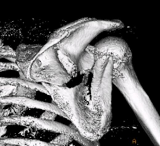 Computed tomographic scan with 3D reconstruction showing the scapula fracture