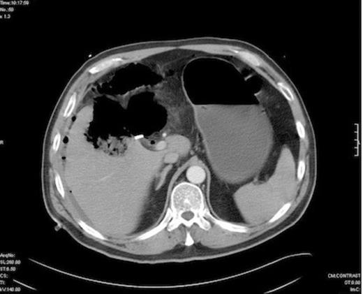 CT at re-admission 1 week post lap chole - Free intraperitoneal gas abscess in gallbladder fossa