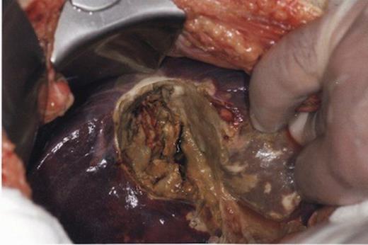 Findings at laparotomy - Purulent slough and emphysema in the gallbladder fossa