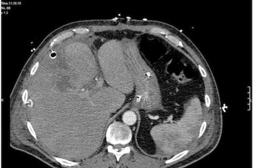 Repeat CT post-laparotomy and lavage showing large bore peritoneal drains