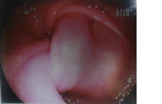 Esophagogastroduodenoscopic examination. Prolapsus and torsion of the bulb of the stomach.