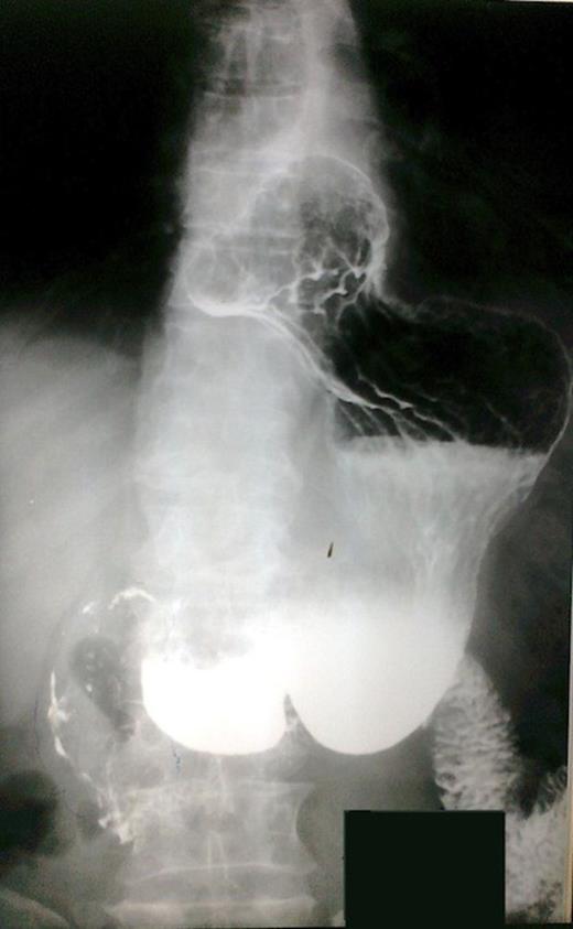 Upper gastrointestinal series. Polypous masses in the bulb and the prepyloric part of the stomach