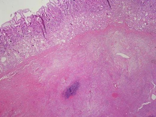 Inflammatory myofibroblastic tumour underneath the mucosa.