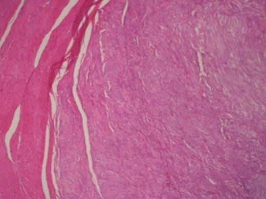 Gastrointestinal stromal tumour in the right and smooth muscle cells in the left.