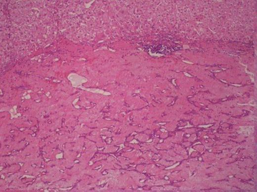 Syringious haemangioma from the superior hepatic surface.