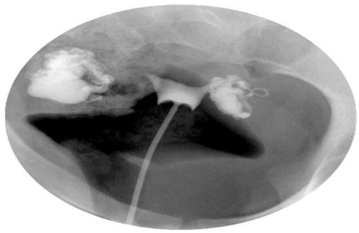 Hysterosalpingogram demonstrating bilateral distal tubal occlusion with hydrosalpinges