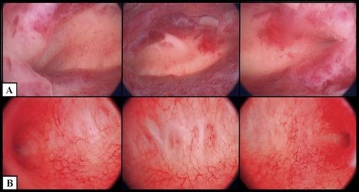 Hysteroscopic appearance of endometrial cavity immediately pre-salpingectomy (A) and six months after interruption of communication with hydrosalpinges (B). For each series, images from left to right depict right cornual, fundal and left cornual regions, respectively.