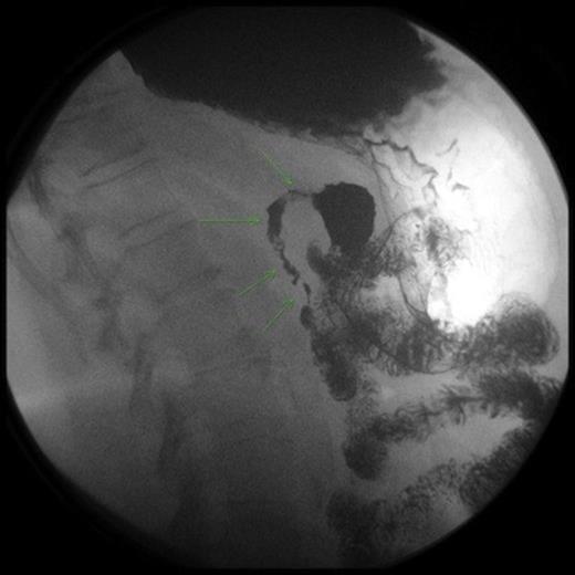 Upper GI series