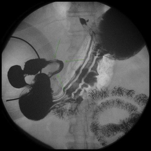 Upper GI series