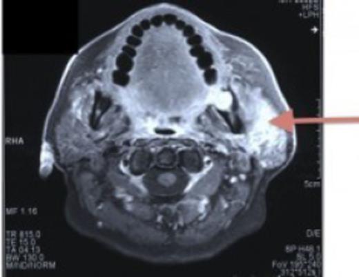 MRI showing soft tissue mass in the left parotid region (denoted by arrow).