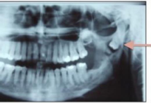 OPG showing ectopic wisdom tooth and cyst (denoted by arrow).