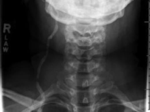 Difussion MRI of the brain prior to syndrome showing no areas of stroke.
