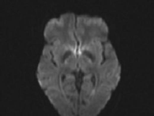 Shunt series showing fracture of shunt catheter at neck.