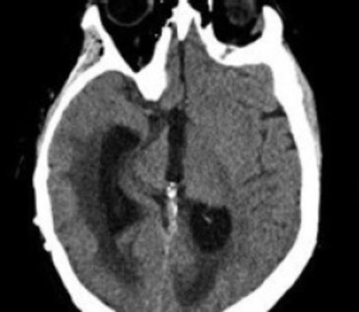 CT scan showing acute enlargement of the ventricles post initial revision demonstrating shunt failure