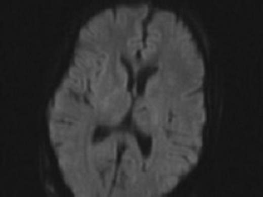 Diffusion MRI showing no strokes post operatively