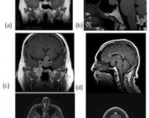 MRI performed in 2000 revealing incidentally discovered pituitary tumor seen on coronal (a) and sagittal (b) views. MRI performed in 2008 revealing enlarging mass within the sella with suprasellar extension on coronal (c) and sagittal (d) views. Axial views reveal metastases in the cerebellum (e) and the parietal lobe (f)