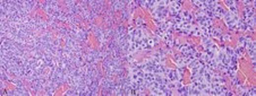 The tumor was growing in a trabecular pattern (a, 200X), including mildly pleomorphic neuroendocrine cells with abundant cytoplasm (b, 400X)