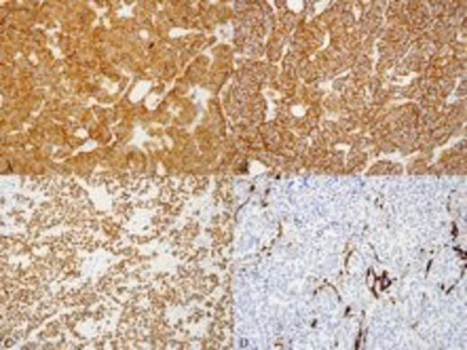 Fig. 3: Immunohistochemical stains confirmed the neuroendocrine nature of the tumor, with positive staining for synaptophysin (a) and CD56 (b). The tumor demonstrated TTF-1 nuclear expression (c) and S100-positive sustentacular cells (d), which are typical features of a pulmonary carcinoid tumor. All images are at 200X magnification