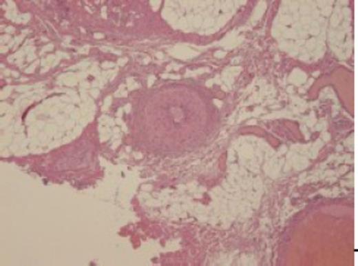 Histopathological findings. Note that the lesion is composed of lobules of mature fatty tissue with various sized vessels