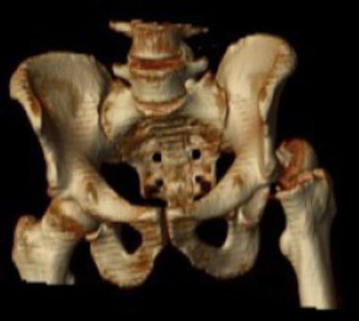 Posterior dislocation of the femoral head with no associated acetabular fracture