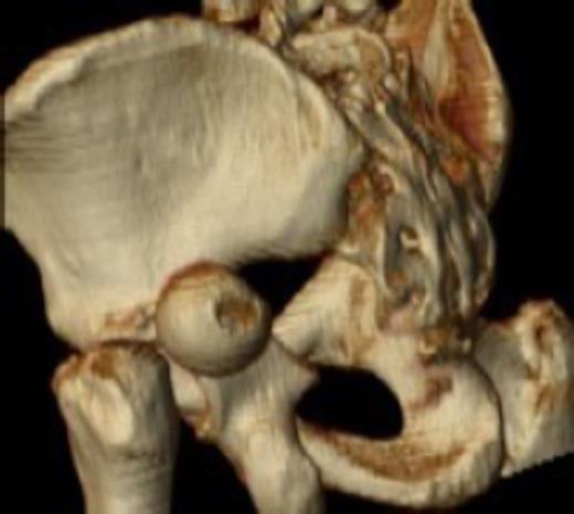 Posterior dislocation of the femoral head with no associated acetabular fracture