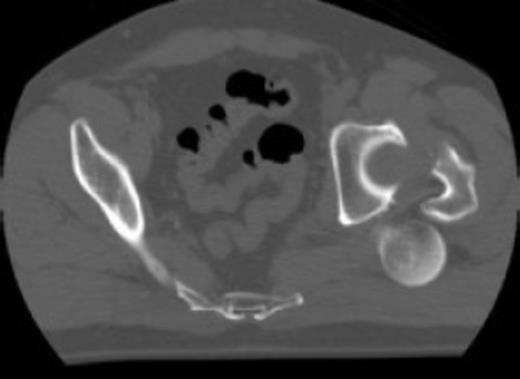 Posterior dislocation of the femoral head with no associated acetabular fracture