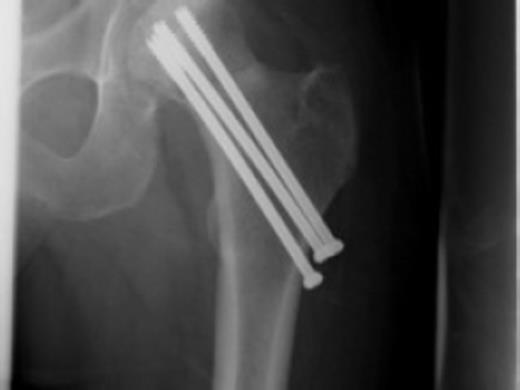 No early displacement or evidence of avascular necrosis