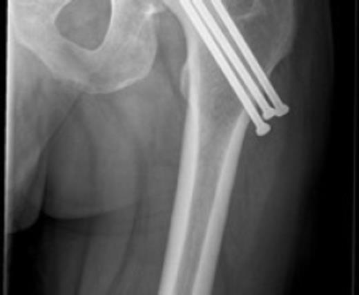 Presence of avascular necrosis