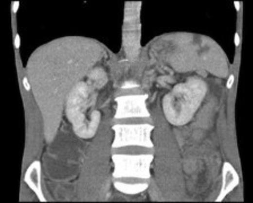 CT showing evidence of splenic infarction secondary to infective endocarditis