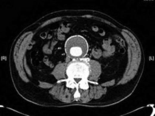 An 82 year old male with 5.8cm AAA of 10.5cm in length