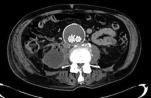 A 50 mm maximum retroperitoneal collection situated between the right kidney and the right iliac vessels
