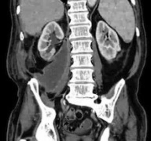 A 50 mm maximum retroperitoneal collection situated between the right kidney and the right iliac vessels