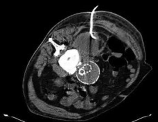 CT guided drainage was carried out using a 10 French gauge pigtail catheter locked pigtail (Meditech Flexima regular all-purpose drainage catheter sets with locking pigtail (Boston Scientific))
