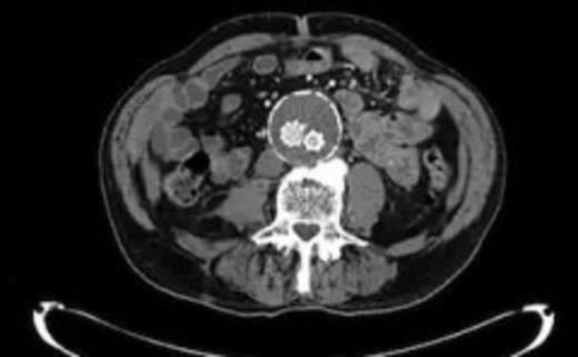 Near complete resolution of psoas collection after 2 weeks of intravenous antibiotics