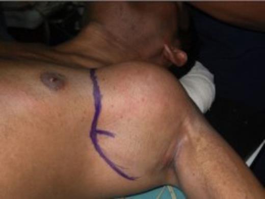 Clinical photograph of pseudoaneurysm of left axillary artery