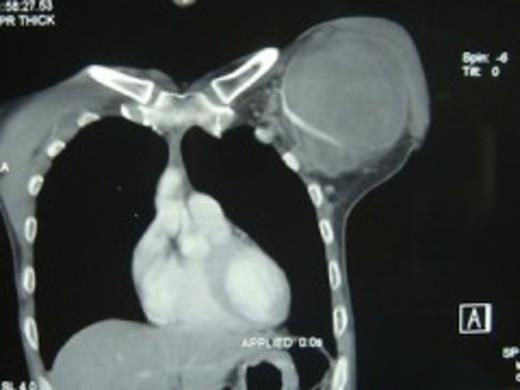 CT angiographic cut showing pseudoaneurysm