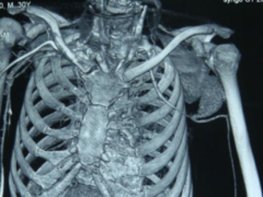 3D Reconstruction of CT angiogram showing displacement of vessel and leakage of blood into pseudoaneurysmal sac