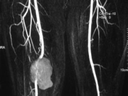 CT angiogram showed a pseudoaneurysm of the lower third of femoral artery