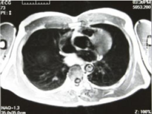 T1 preoperative magnetic resonance imaging - high intensity signal lesion was found in the posterior mediastinum, suggestive of a bronchogenic cyst