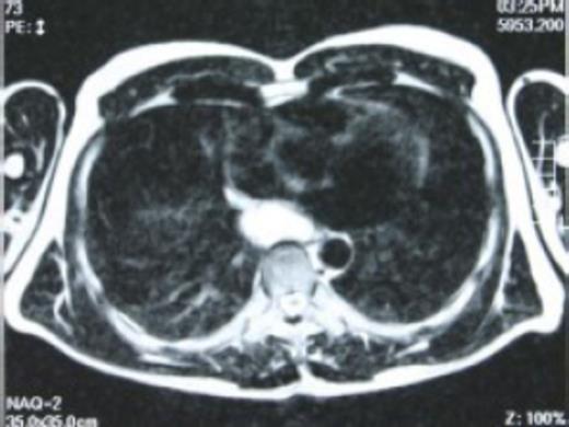 T2 preoperative magnetic resonance imaging - high intensity signal lesion was found in the posterior mediastinum, suggestive of a bronchogenic cyst