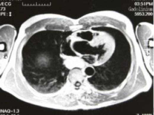 Gadolinium enhanced preoperative magnetic resonance imaging - high intensity signal lesion was found in the posterior mediastinum, suggestive of a bronchogenic cyst