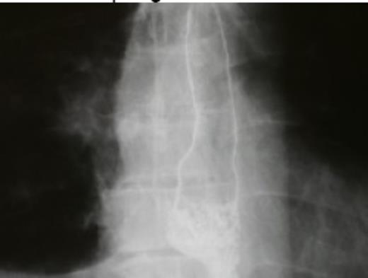 Postoperative barium swallow test (2 weeks after surgery)